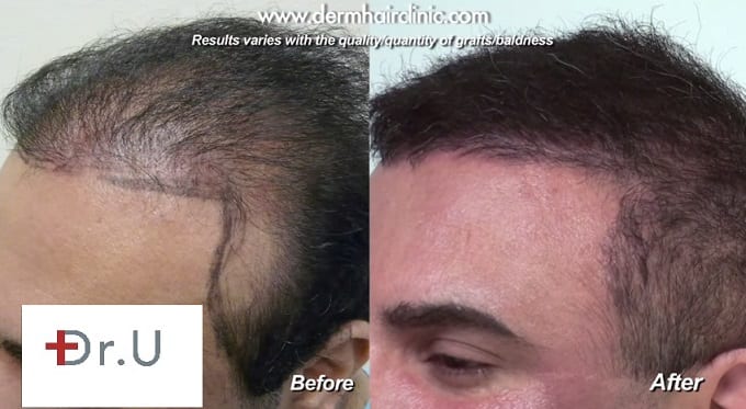 Video - Temple Hair Restoration Using  Advanced FUE