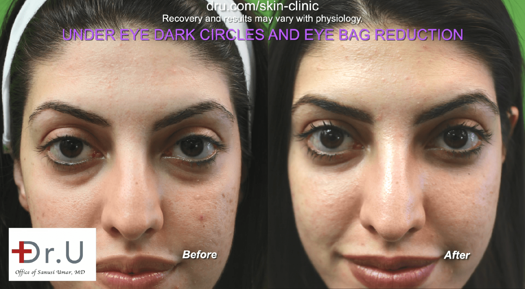 Under Eye Bags Removal | CK Eyelid Plastic Surgery