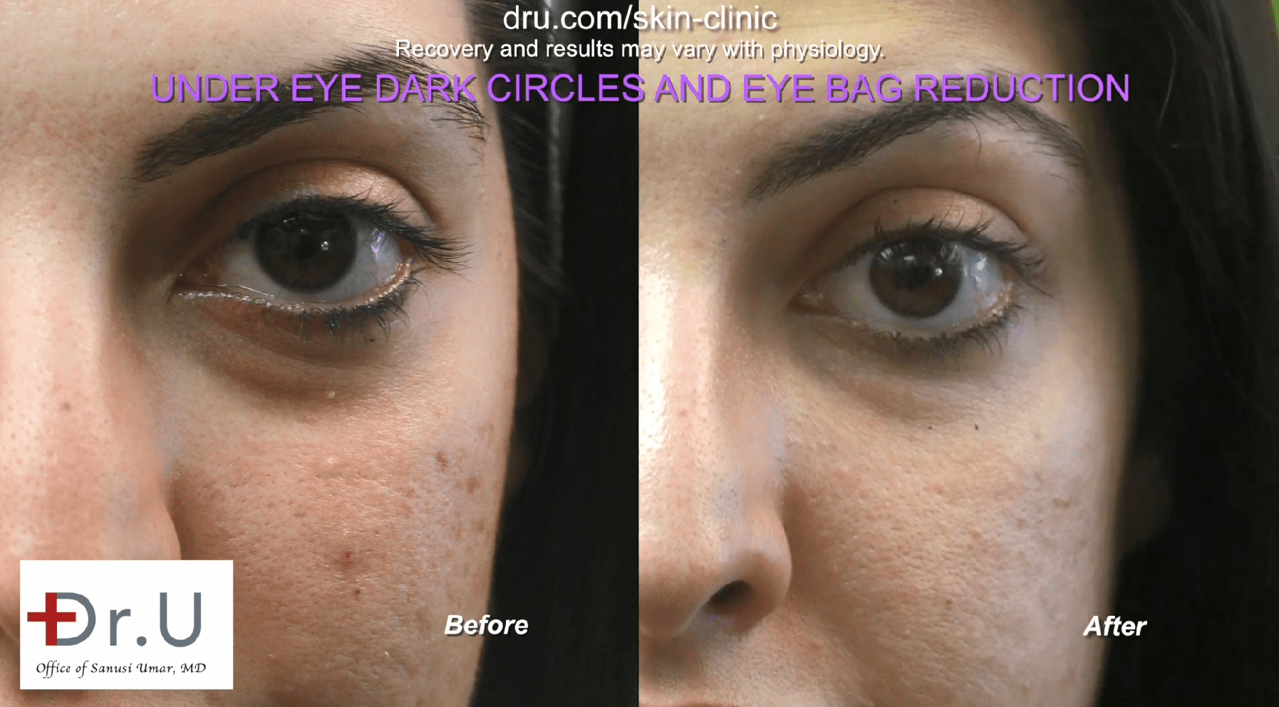 Common Types Of Eye Bags And How To Remove Them | DAPS