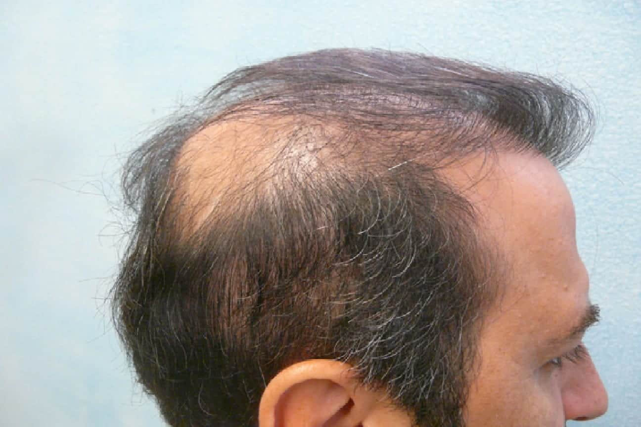 Hair Transplant for the Crown: Before or After a Hairline Restoration?