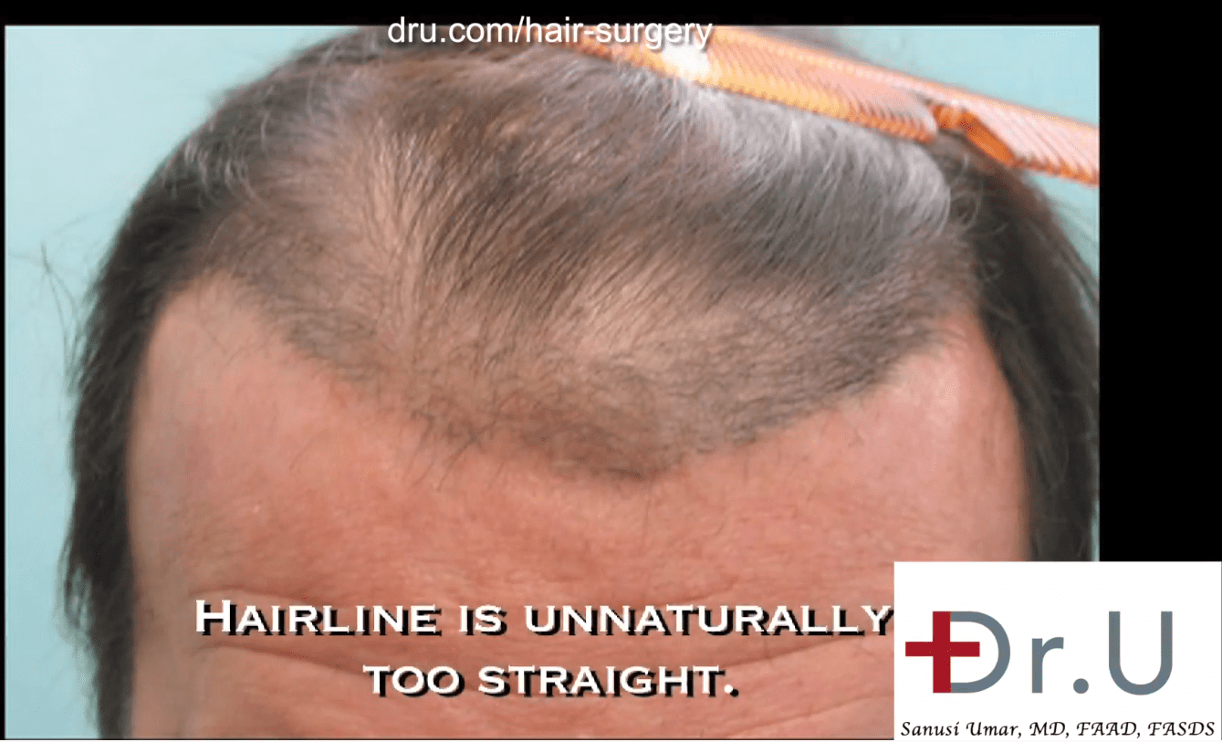 Hair Flap Surgery and Repair of Hairline and Scarring Using FUE