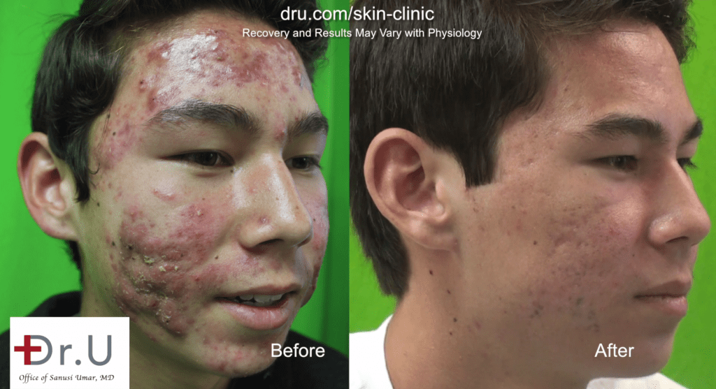 Skin Clinic Patient Results | Manhattan Beach, Los Angeles | Dr. Umar