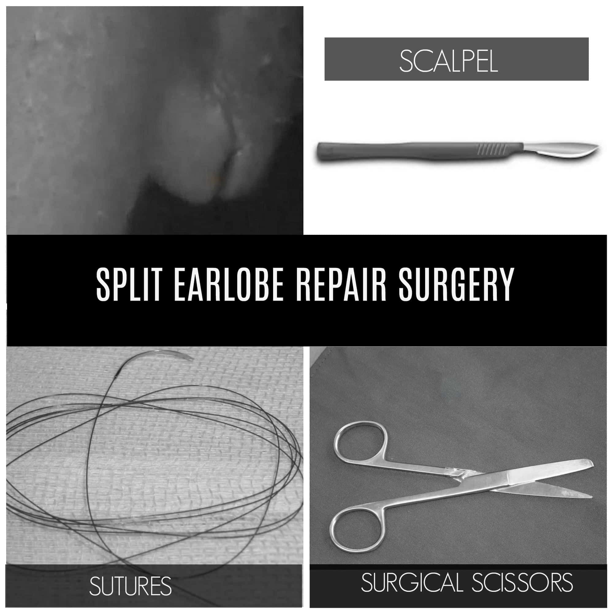 Earlobe Repair Houston 👂 - Split & Torn Earlobe Surgery