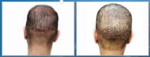 Hair Transplant Reparative Surgery by Dr. Umar in Manhattan Beach, Los Angeles