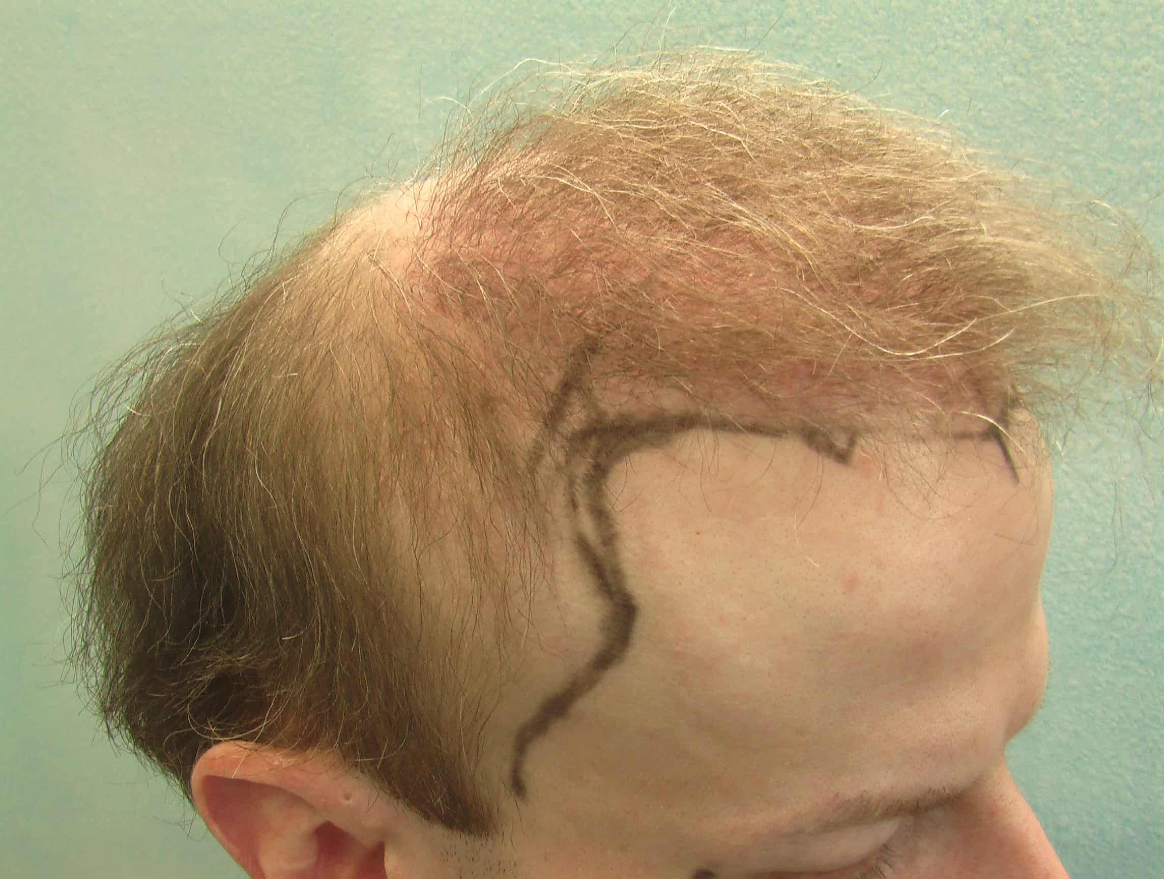 Video - Temple Hair Restoration Using  Advanced FUE
