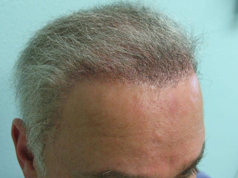 Hair Flap Surgery and Repair of Hairline and Scarring Using FUE
