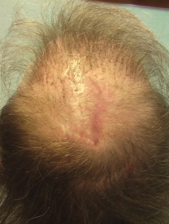 The Risks Of Scalp Reduction And Repair For Baldness Reduction