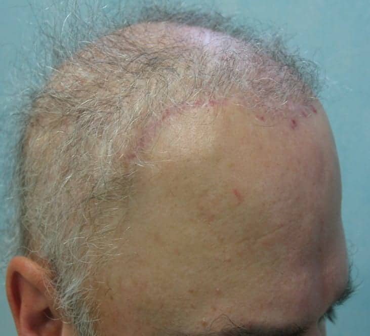 Hair Flap Surgery and Repair of Hairline and Scarring Using FUE