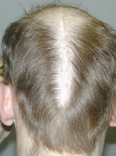 crown of head hair loss