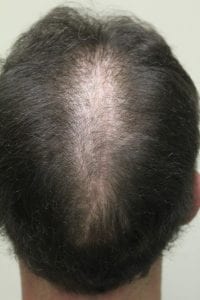 The Risks of Scalp Reduction and Repair for Baldness Reduction