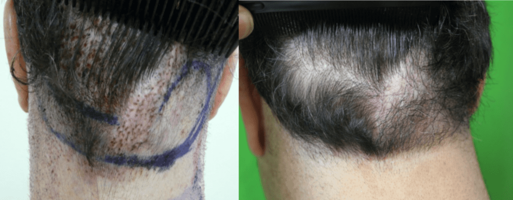 Hair Flap Surgery and Repair of Hairline and Scarring Using FUE