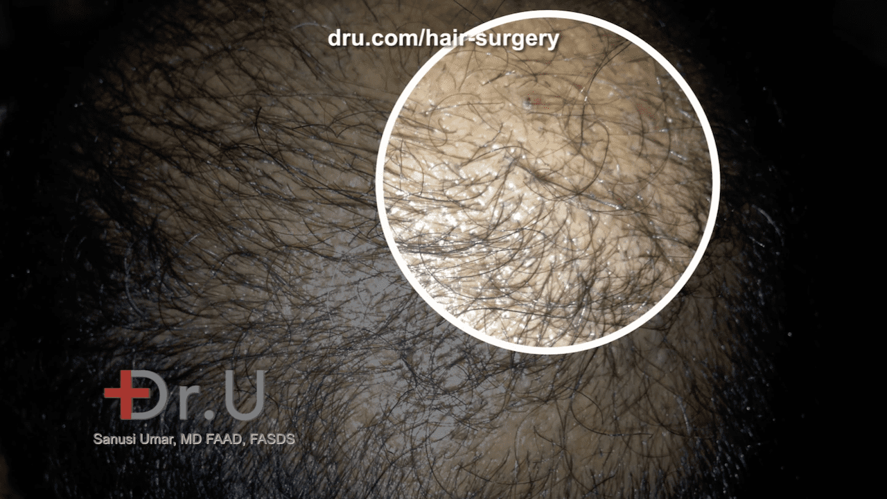 Video: Pimples After a Hair Transplant and Why They Form | Dr. U