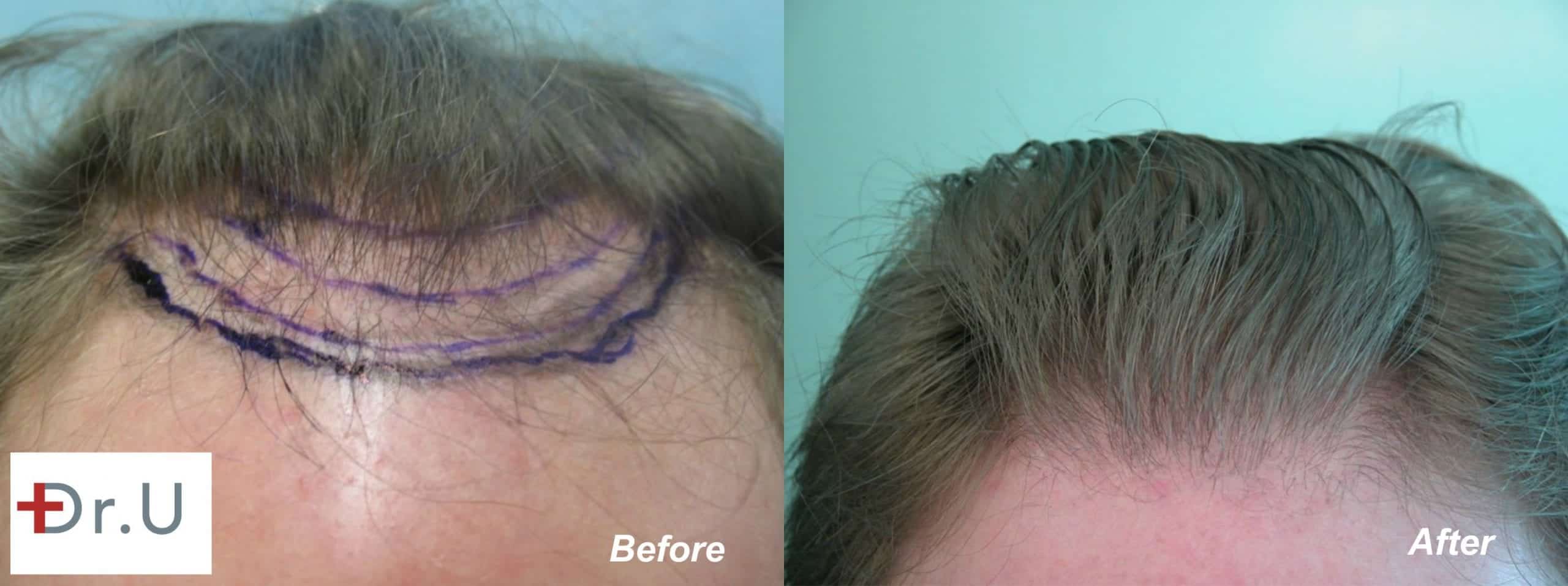 VIDEO Using Nape Hair in Hairline Reconstruction to Fix Bad Hairline