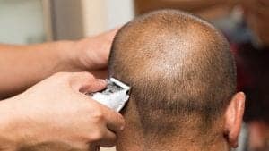 Have you noticed bumps on your head after a shave? While it may be tempting to brush off these bumps as just a barber's rash, they could be symptoms of a skin condition known as AKN.