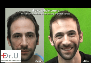 Hollywood, Los Angeles patient before and after his celebrity hair restoration