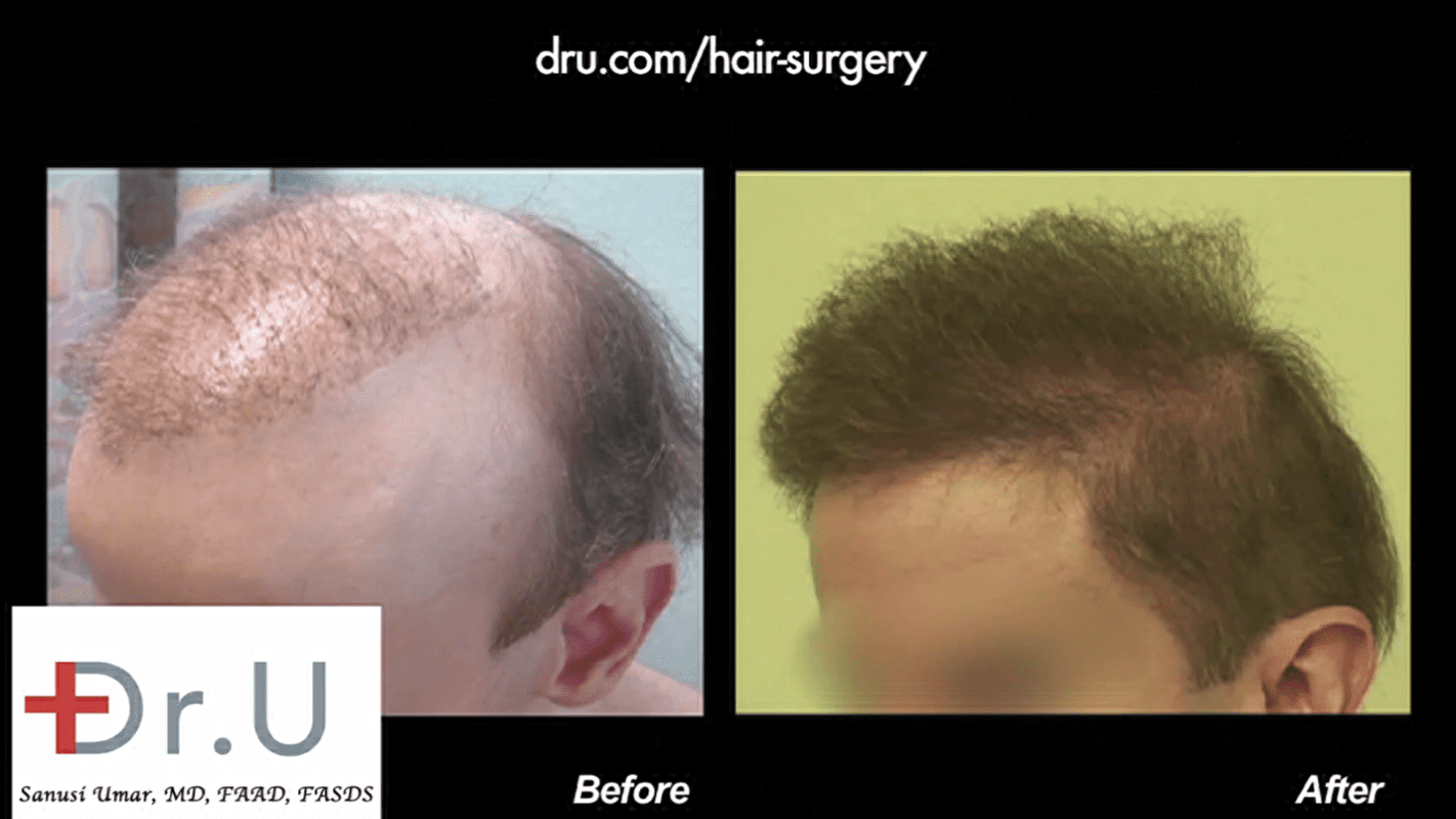 Video - Hair Transplant Disaster Solved By  Using Body Hair Grafts