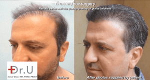 Record breaking hair transplant surgery  6 months have passed