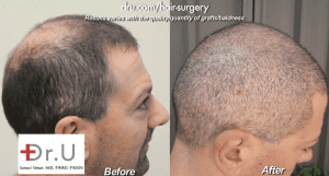 10000 Grafts Hair Transplant Cost in Islamabad  Pakistan  Price