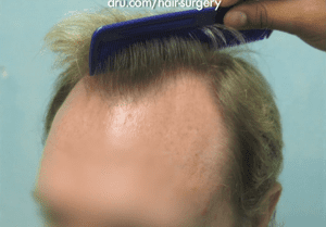 Treatment for Advanced Hairline Recession