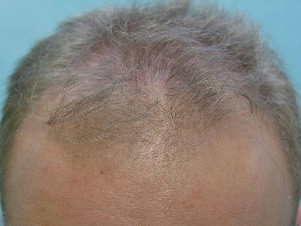 Video: Fue Hairline Reconstruction Reverse Hair Thinning Result