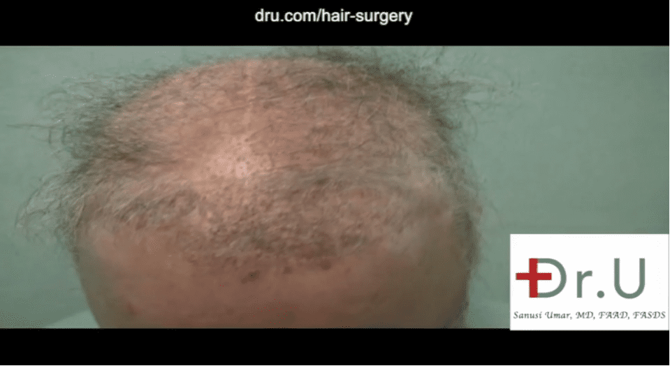 VIDEO - 10,000 Graft Body Hair Transplant For Repairing A Depleted Donor  Scalp