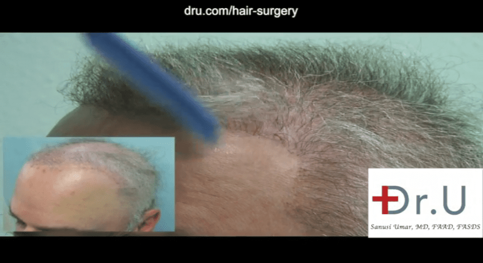 VIDEO - 10,000 Graft Body Hair Transplant For Repairing A Depleted Donor  Scalp