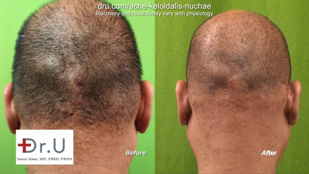 Acne Keloidalis Nuchae Patient Results - Dr. U Hair & Skin Clinic | FUE