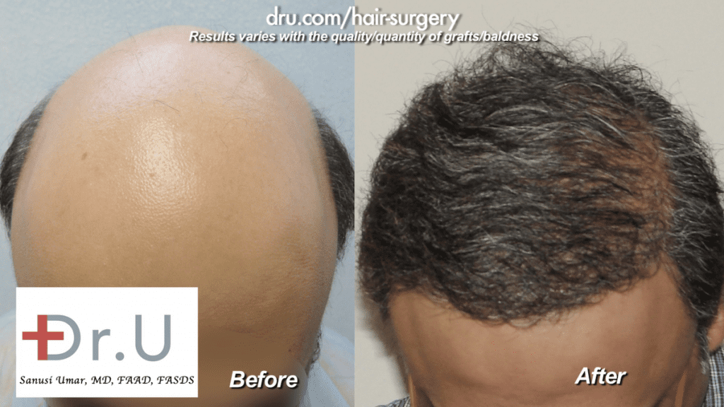 Using advanced Dr.UGraft technology, Dr. Umar was able to meet this severely bald patient's graft estimate with 8,000 grafts from the head combined with an additional 4,000 from the bear donor area. Dr. UGraft enabled the augmentation of the donor supply to meet how many grafts needed for hair transplant - 12,000 in total.