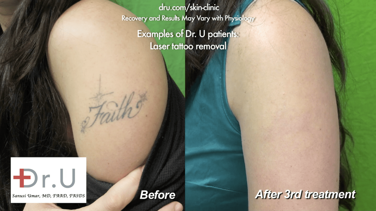Best tattoo removal clinic in Bangalore  No1 Tattoo Removal Clinic Laser