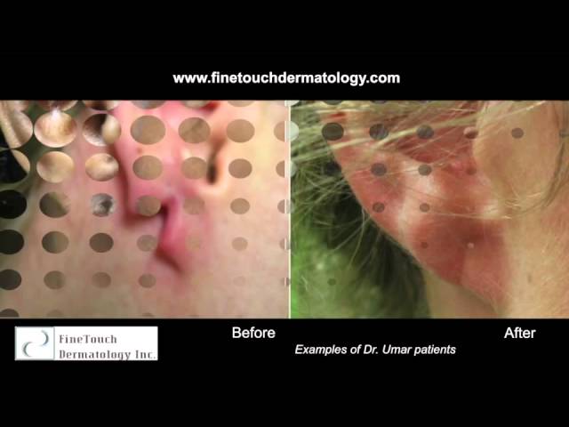 Split earlobe – Miracle Skin Hair and Aesthetic Clinic