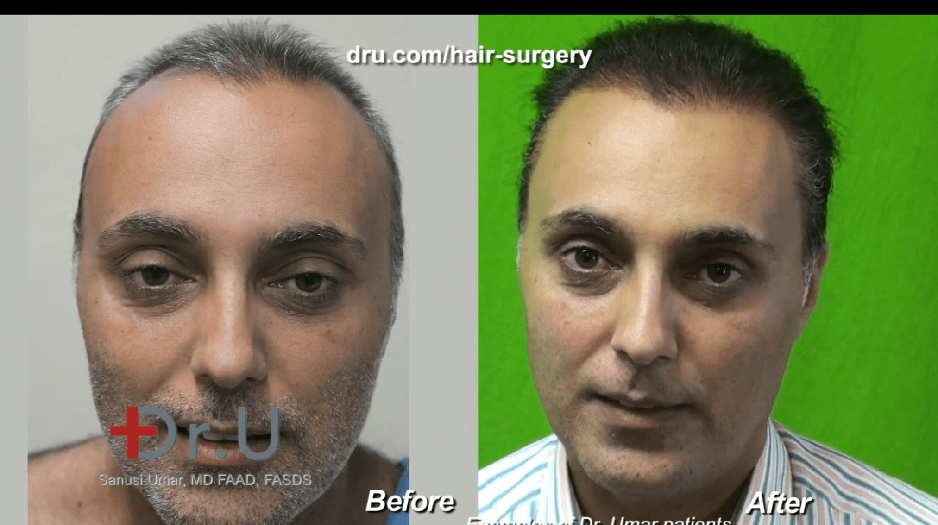 Q&A Video : How Long Does it Take to See Results After a Hair Transplant