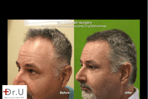 Conservative Hair Transplant for Mature Hairline