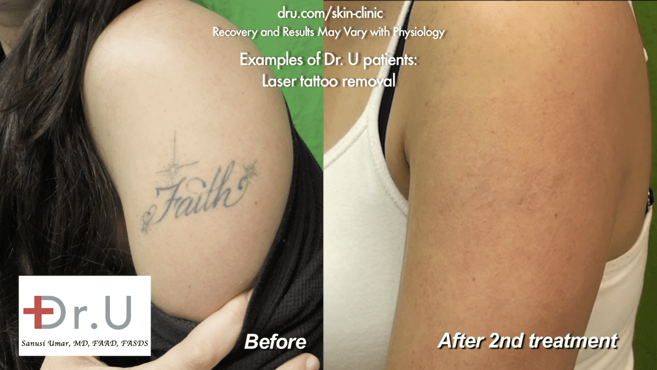 Video: Dr. U Answers Your Questions - Tattoo Removal With Laser