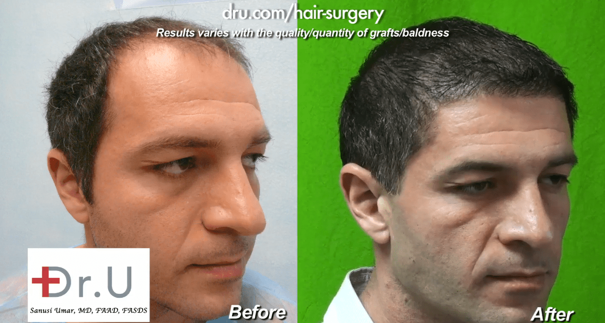 Hair transplant before and after What to expect  The Upcoming