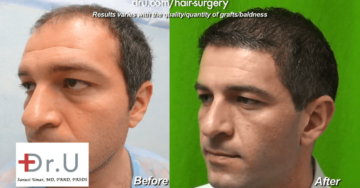 7000 Grafts Hair Transplant Turkey  Operation and Cost  Heva Clinic