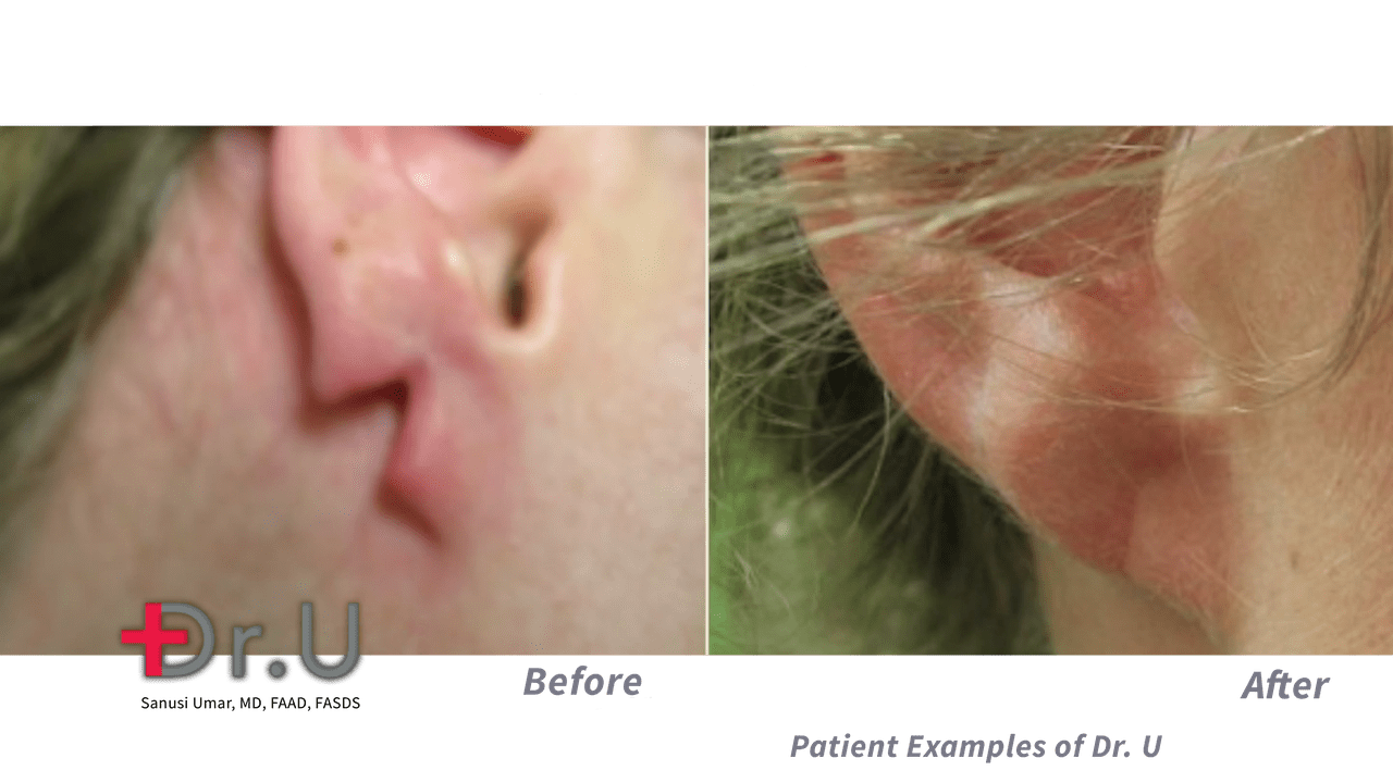 A-Z of treating a torn earlobe without surgery!