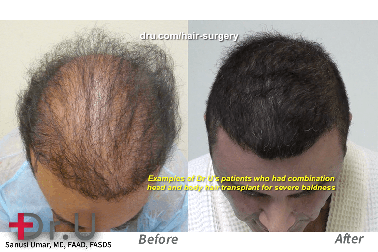 Video: What is FUE Hair Transplant Donor Overharvesting?  Answers
