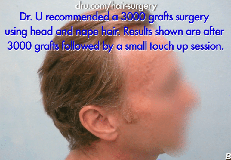 Video: The  Solution for a Receding Hairline Issue