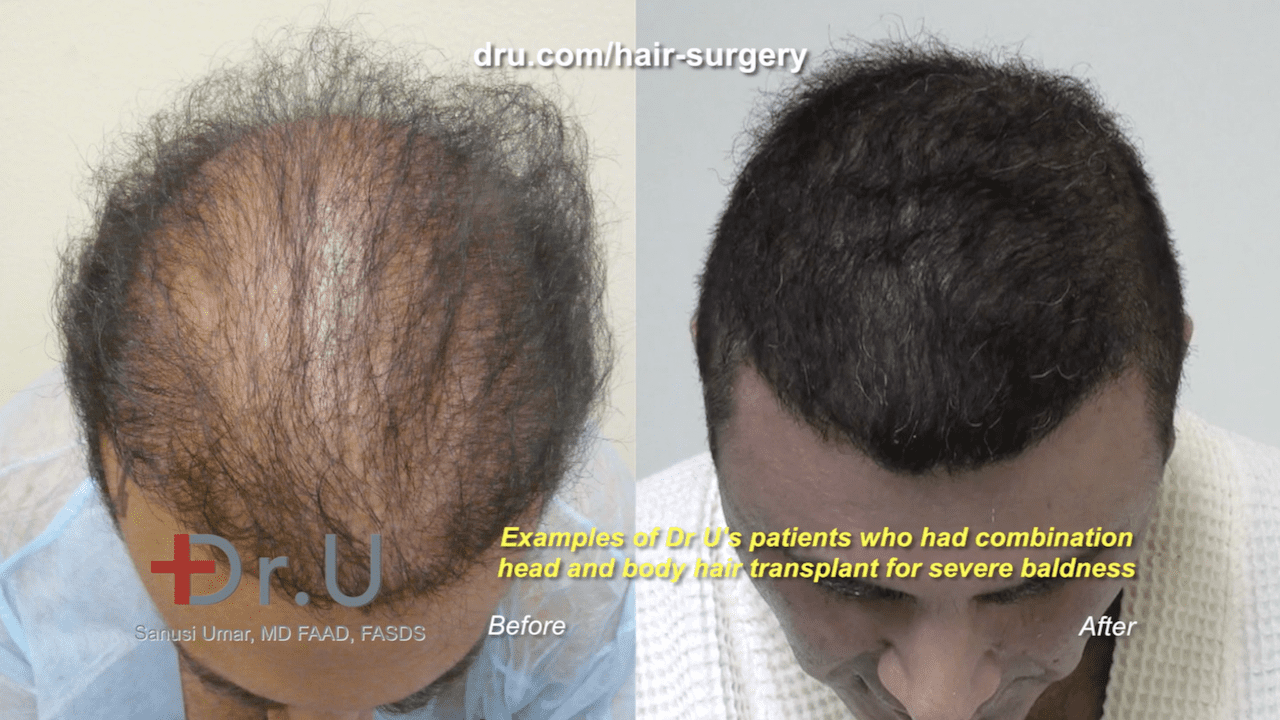 Video: What is FUE Hair Transplant Donor Overharvesting?  Answers