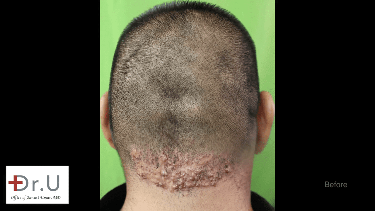 Video: Patient Struggling With Razor Bumps Behind Head Find Cure 