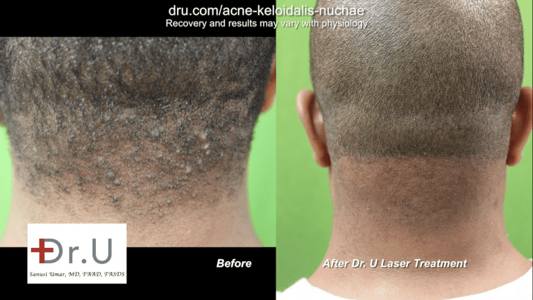 Acne Keloidalis Nuchae Laser Treatment Results Archives Dr U Hair