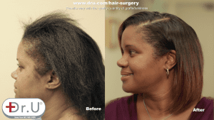 What's the best treatment for traction alopecia? According this happy patient, its a Dr.UGraft linear scar-free FUE hair transplant.