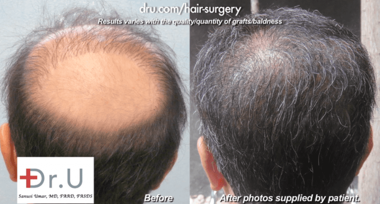 VIDEO: Can You Wear Wigs and Hairpieces After Hair Transplant ?