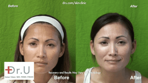 Beverly Hills patients laser skin resurfacing before and after results.