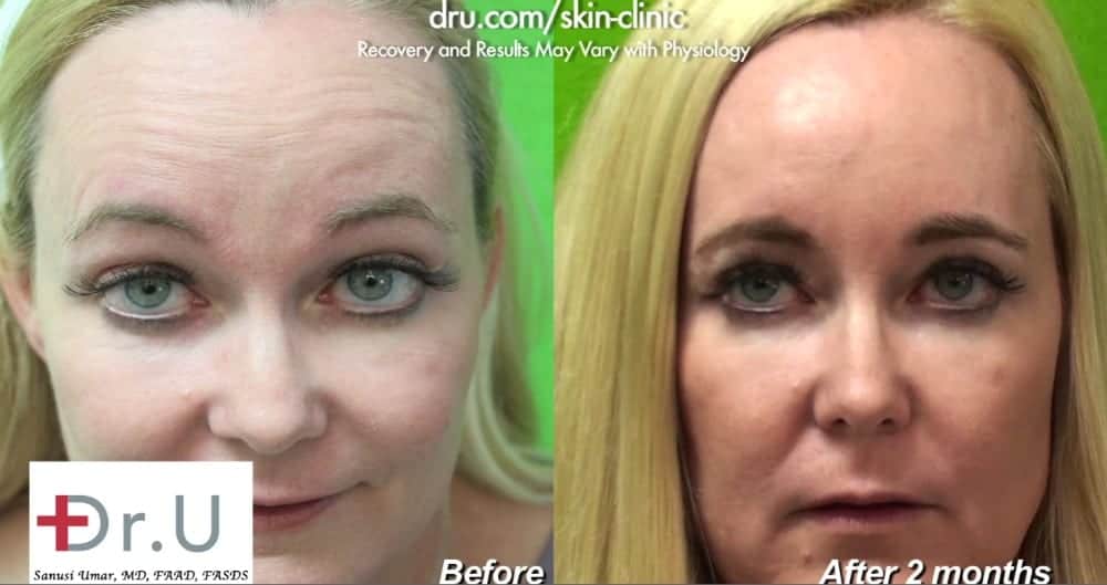 Botox for Crows Feet and Forehead Lines