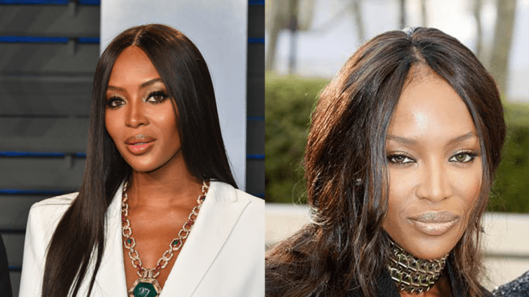 Many were shocked when, at a 2012 appearance in London, Naomi Campell appeared to have significant hair loss on her front hairline, in between her signature middle part (right). Campell is known for her sleek, long black hair, parted in the middle, which serves to accentuate the symmetry of her facial features (left). This stark change had people wondering, can traction alopecia be reversed? Many were shocked when, at a 2012 appearance in London, Naomi Campell appeared to have significant hair loss on her front hairline, in between her signature middle part (right). Campell is known for her sleek, long black hair, parted in the middle, which serves to accentuate the symmetry of her facial features (left). This stark change had people wondering, can traction alopecia be reversed?