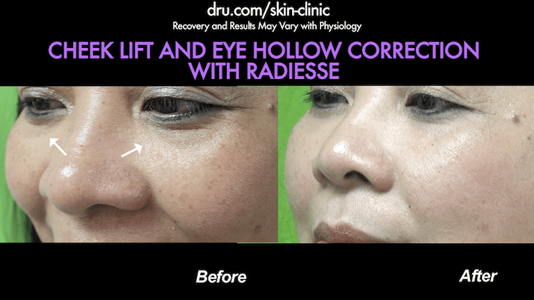 After consulting with Dr. U about a minimally invasive procedure and the non surgical cheek augmentation cost, this El Segundo, Los Angeles patient was pleased with her results.