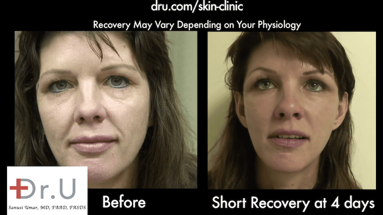 Silhouette Lift Tightens Face