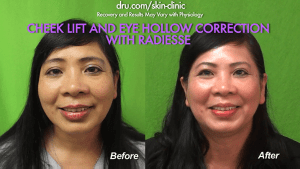 El Segundo, Los Angeles patient before and after the best non surgical cheek lift at Dr. U Skin Clinic.