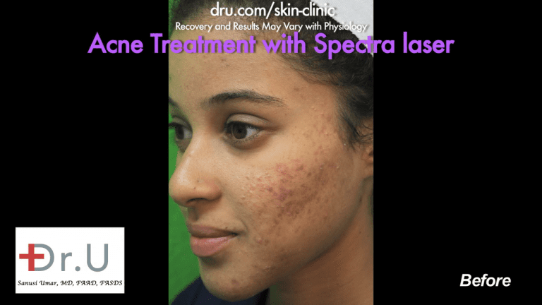 This Santa Monica patient consulted Dr. U about a laser treatment for Acne. Due to her skin type, Dr. U recommended the Spectra laser for safe and effective treatment. This Santa Monica patient consulted Dr. U about a laser treatment for Acne. Due to her skin type, Dr. U recommended the Spectra laser for safe and effective treatment.
